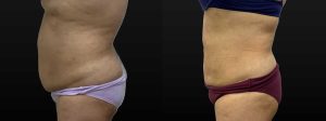 PSSVA Liposuction Procedures Patient 7b
