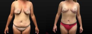 PSSVA Mommy Makeover Procedures Patient 2a