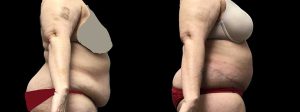 PSSVA Panniculectomy Procedures Patient 1b
