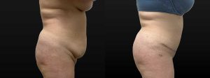 PSSVA Panniculectomy and Lipo Procedures Patient 1b