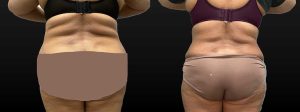 PSSVA Panniculectomy and Lipo Procedures Patient 4a