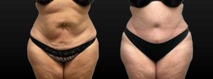 PSSVA Tummy Tuck Procedures Patient 7a