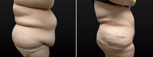PSSVA Weight Loss Procedures Patient 12a