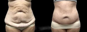 PSSVA Weight Loss Procedures Patient 3b