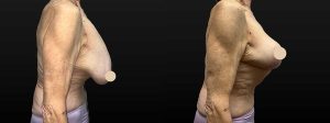 PSSVA Weight Loss Procedures Patient 7b