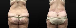 PSSVA Weight Loss Procedures Patient 8b