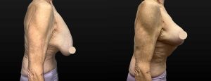 PSSVA Breast Lift Procedures Patient 5a