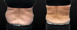 PSSVA Liposuction Procedures Patient 3c
