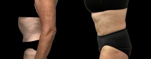 PSSVA Liposuction Procedures Patient 5a