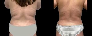 PSSVA Liposuction Procedures Patient 9b