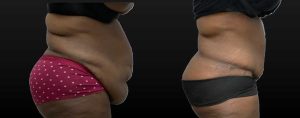 PSSVA Panniculectomy Procedures Patient 3b