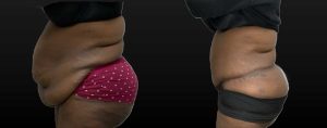 PSSVA Panniculectomy Procedures Patient 3c