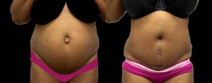 PSSVA Tummy Tuck Procedures Patient 3b
