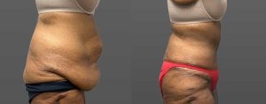 PSSVA Weight Loss Procedures Patient 1a