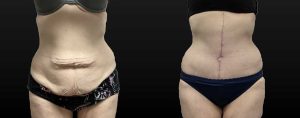 PSSVA Weight Loss Procedures Patient 5a