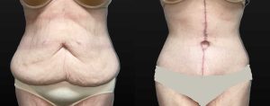 PSSVA Weight Loss Procedures Patient 9b