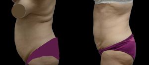 PSSVA Liposuction Procedures Patient 6a