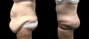 PSSVA Weight Loss Procedures Patient 4b