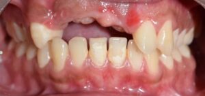 Implant Prosthesis Before