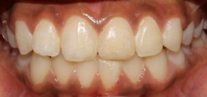 Replantation_of_tooth_post_trauma_After