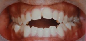 open-bite-before