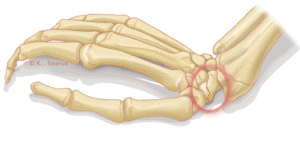 Scaphoid fracture