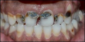 Esthetic_restoration_of_grossly_decayed_teeth_Before