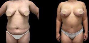 PSSVA Liposuction Procedures Patient 9a