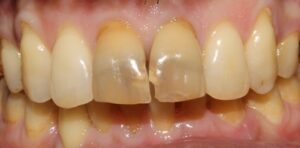 Tooth_Bleaching_Before