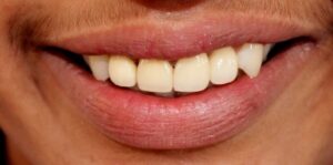 Smile_designing_with_fixed_crowns_after1