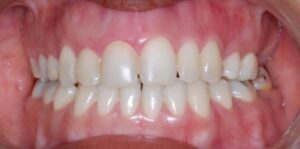 open-bite-after