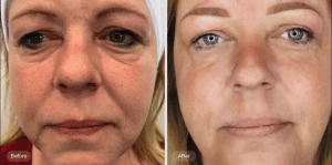 Plexr Plus Treatment for Eyes in Regina