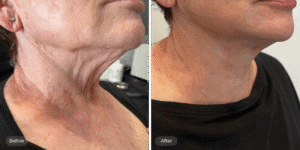 Radiofrequency Course in Regina at Visage Medical Aesthetics To Boost Your Knowledge in Medical Aesthetics