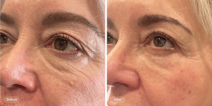Best Treatment for Under Eye Hollows in Regina