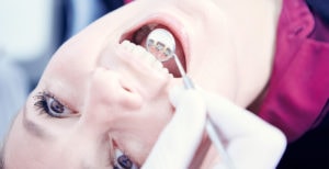 Lingvālās breketes WIN / incognito.