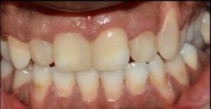 Esthetic_restoration_of_grossly_decayed_teeth_After