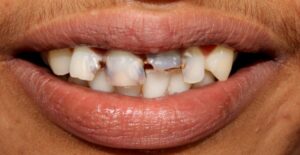 Smile_designing_with_fixed_crowns_Before1