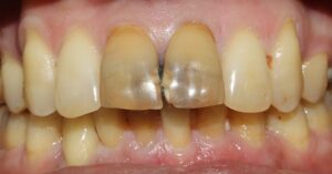 Tooth_Bleaching_After