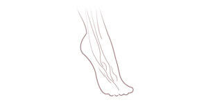 Drop Foot