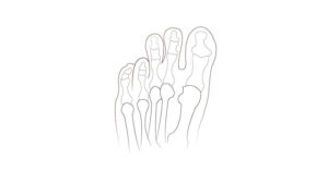 Short Toe Surgery