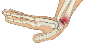 Smith’s fracture
