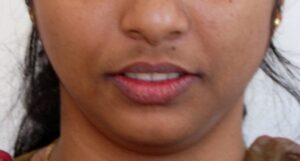 facial-harmony-and-esthetics-after