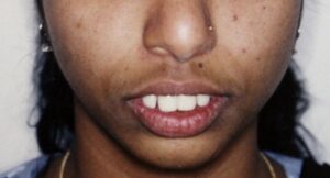 facial-harmony-and-esthetics-before