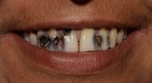 Smile_designing_with_fixed_crowns_Before