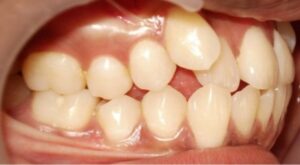 correction-of-irregular-teeth-before