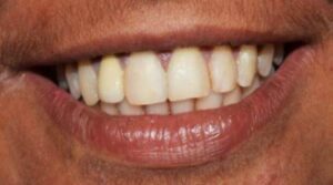 Smile_designing_with_fixed_crowns_after