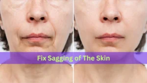 Fix Sagging of the face