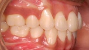 correction-of-irregular-teeth-after