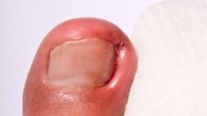 ongles incarnes 332x200