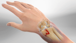 Distal radius fracture
